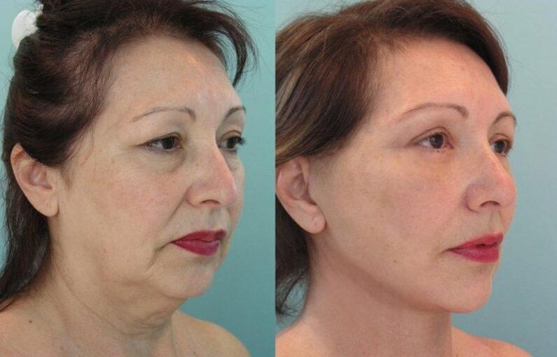 The result of facial skin rejuvenation by tightening with threads